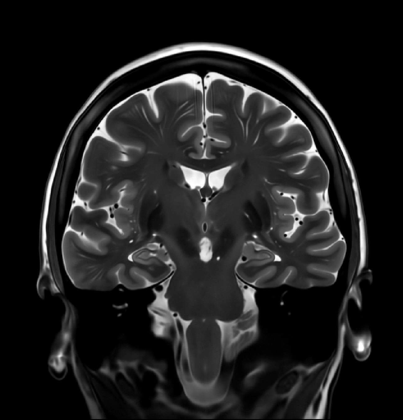 As-acquired TSE image for MPRAGE case